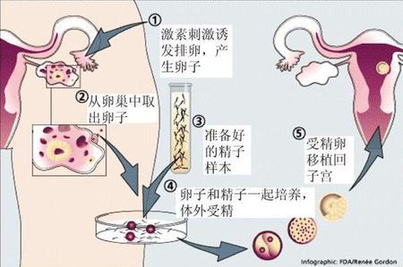 靠谱借卵代怀多少费用